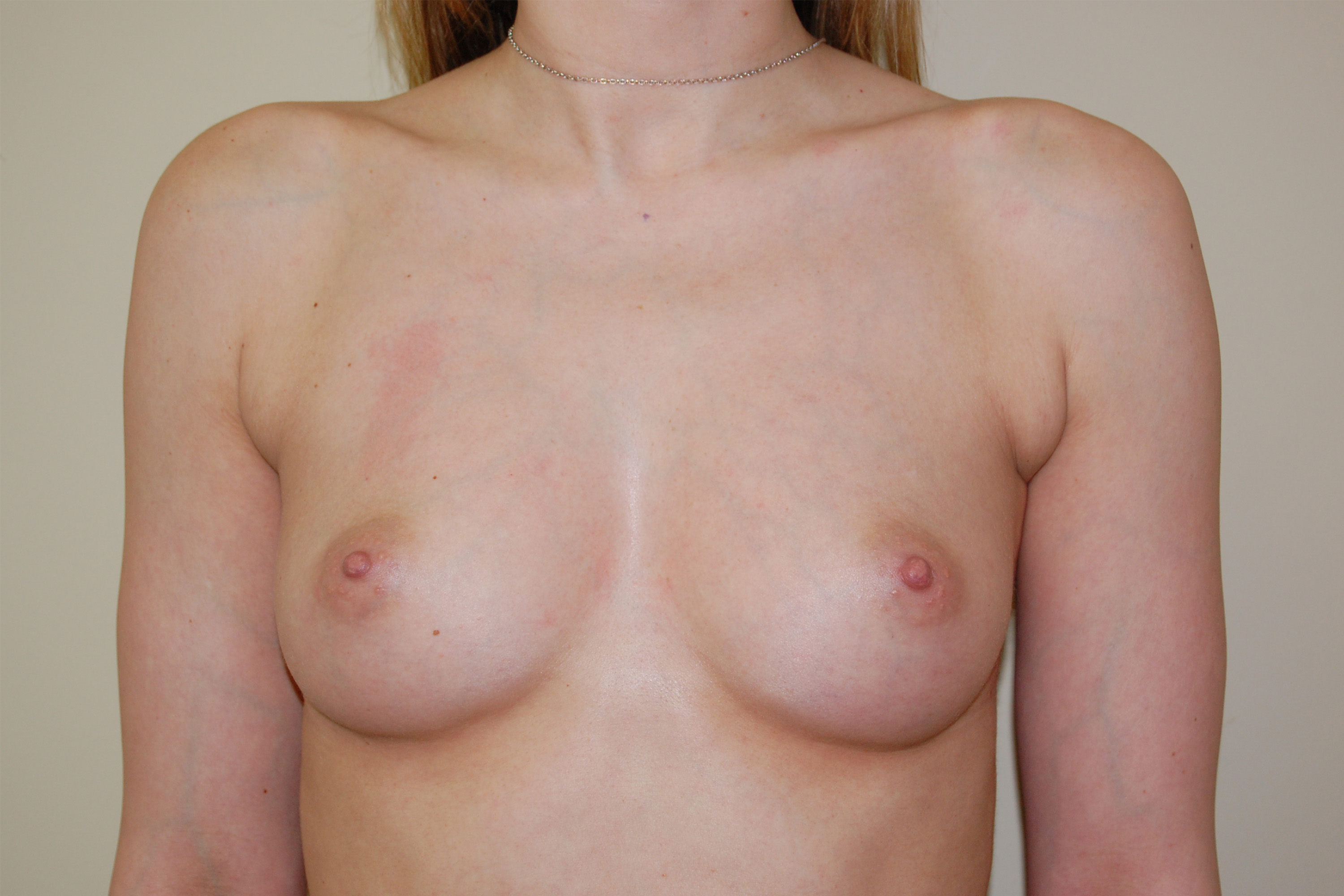 Breast Augmentation Front Before